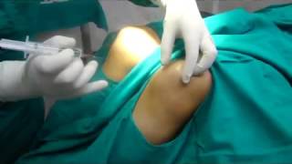 PRP Stem Cell Therapy Prolozone Therapy in Delhi INTRA ARTICULAR OZONE INJECTION FOR KNEE [upl. by Netti906]