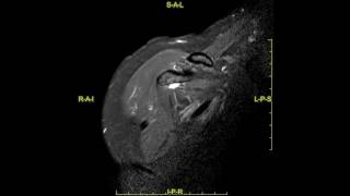 Perthes lesion of the shoulder  complete MRI examination [upl. by Marinelli]