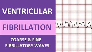 Ventricular Fibrillation VFib ECG Interpretation Nursing Heart Rhythms NCLEX ACLS [upl. by Iraj]