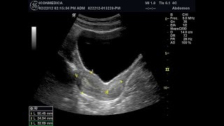 ECOGRAFÍA ABDOMINO PÉLVICA  ECOGRAFÍA DE ÚTERO Y ANEXOS  ULTRASONIDO ABDOMINAL ECOGRAFÍA OVARIOS [upl. by Nnaytsirk]