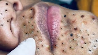 Top blackheads removal  acne treatment and very very satisfying [upl. by Ramsdell557]