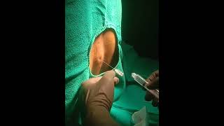 Anaesthesia  Best technique  best care 💥💪💥 DR 💪💪 spinal anaesthesia [upl. by Liddie]