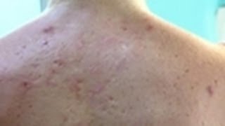 Cystic Acne  Embarrassing Bodies [upl. by Aivizt969]