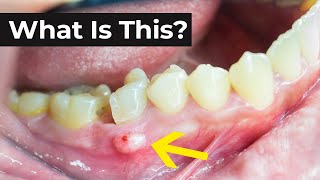 What is an Abscessed Tooth amp What To Do About It [upl. by Bathesda699]