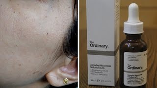 Ascorbyl Glucoside 12I applied this product for 30 days and this happened  Review  BeautywdBrain [upl. by Cathee428]