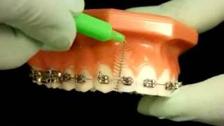 Bracesquestionscom  Brushing With Braces How to Brush Teeth [upl. by Queenie]