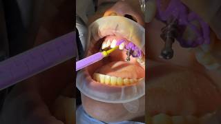 Open Tray Impression with Panasil XLight and Tray Soft Heavy kettenbachusa dentist impression [upl. by Asereht]