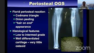 Osteosarcoma Current Concepts [upl. by Radnaskela]