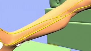 Heres how percutaneous tibial nerve stimulation PTNS provides relief from overactive bladder [upl. by Aihsal]