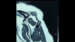 CASO CLINICO RESONANCIA MAGNETICA HOMBRO [upl. by Nnayr851]