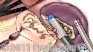 Spleen Removal Surgery Laparoscopic Splenectomy PreOp® Patient Education [upl. by Airotkiv]