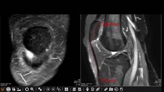 Patellar tendonlateral femoral condyle friction syndrome Hoffa fat pad impingement syndrome [upl. by Shana180]