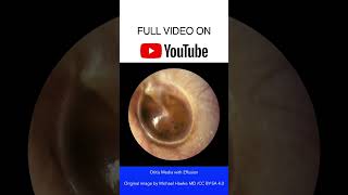 Otitis Media with Effusion Otoscopy [upl. by Maletta]