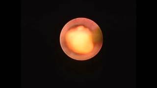 Salivary Endoscopy with Stone Removal [upl. by Allenotna]