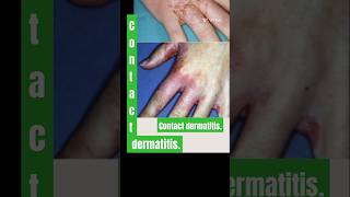 Contact dermatitis dermatology dermatologist gk medicalstudent [upl. by Grosz]