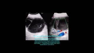 Retroperitoneal complex cystic lesion  hydatid disease  abscess [upl. by Imas]