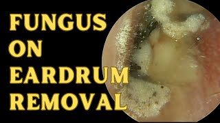 Aspergillus Niger Sits On Eardrum [upl. by Okkin]