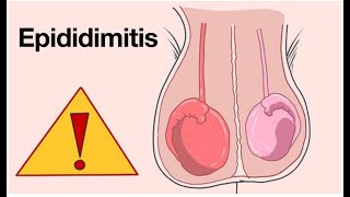 Epididimitis  Causas y tratamiento  Dolor testicular  Infección testicular [upl. by Leidgam]