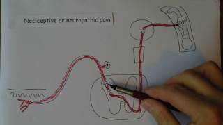 Neuropathic pain [upl. by Elletnohs]