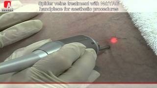 SPIDER VEINS TREATMENT NdYAG [upl. by Nael494]