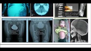 osteopetrosis  مرض التعظم [upl. by Gunthar]