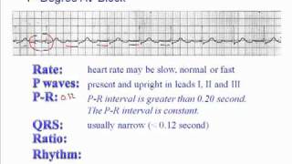 ECG 1st Degree AV Block [upl. by Nivert627]