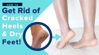 Get Rid of Dry Cracked Feet FAST amp NATURALLY  AT HOME REMEDIES UPDATE [upl. by Rufe433]