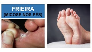 MICOSE NOS PÉS Frieira  Como combater Por Luiz Gameiro dermatologista [upl. by Ruphina]