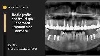 Caz clinic implanturi dentare si coroane [upl. by Noremmac213]