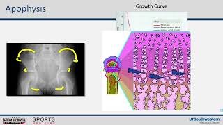 Hip and Pelvis Apophysitis [upl. by Nesta]