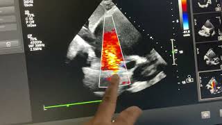 IVC type sinus Venosus ASD with partial anomalous pulmonary Venous connection ￼ [upl. by Ytteb]