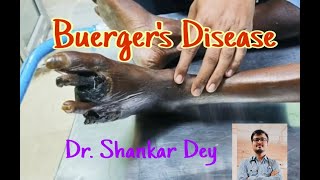 Buergers Disease  Case Demonstration  Dr Shankar Dey [upl. by Eillas]