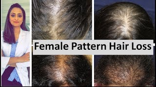 Hair loss in women  Female Pattern Hair Loss  causes amp treatment  Dermatologist [upl. by Nalyd]