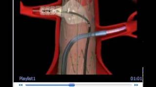 Zenith Fenestrated AAA Endovascular Graft [upl. by Edelman220]