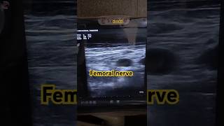 USG guided femoral nerve block femoralnerve anaesthesia usg [upl. by Accire]