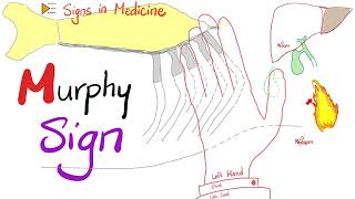 Murphy Sign for Cholecystitis  Signs in Medicine Series [upl. by Yannodrahc]