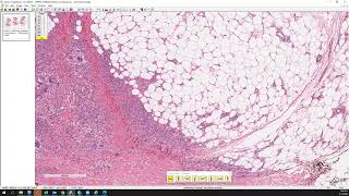 Erythema nodosum [upl. by Britte]