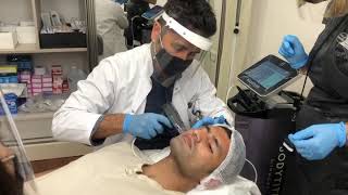 Morpheus 8 Skin Tightening Radiofrequency with Microneedling [upl. by Notnil]