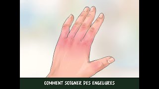 Comment soigner des engelures [upl. by Ecirtaeb]