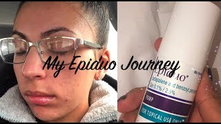 My Epiduo Journey Weeks 12 [upl. by Ingraham]