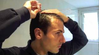 Tratamiento laser capilar domiciliario  Hair loss laser treatment home use [upl. by Arremat]