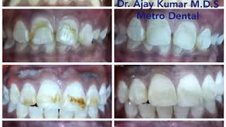 Teeth whitening Dental Bleaching  Dental fluorosis [upl. by Koller709]