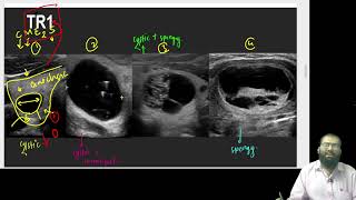 USG THYROID TIRADS PART 3 [upl. by Mcintyre]