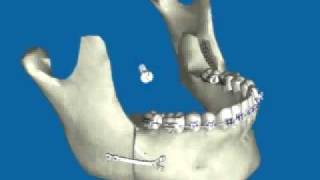 Retroceso de Mandíbula por Prognatismo Mandibular [upl. by Ylrebmek]