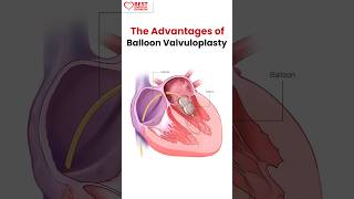 Advantages Of Balloon Valvuloplasty [upl. by Enerak583]