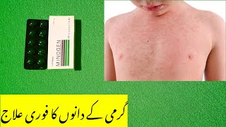 Garmi ke dano ka ilaj  Prickly heat treatment  Heat Rash Treatment  pit ki dawai [upl. by Dam440]