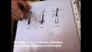 électrolyse epilation par la thermolyse explication [upl. by Sivat]