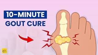 10Minute Gout Cure for Quick Relief and Recovery  Credihealth [upl. by Allare]