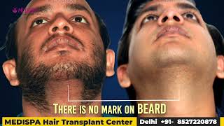 5000 Grafts Hair Transplant Results in grade 6 at Medispa By Dr Suneet Soni [upl. by Singh]