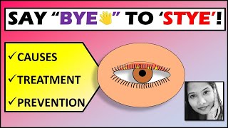 quotGoodbye Styequot  Stye Treatment amp Prevention  External Hordeolum [upl. by Trenton469]